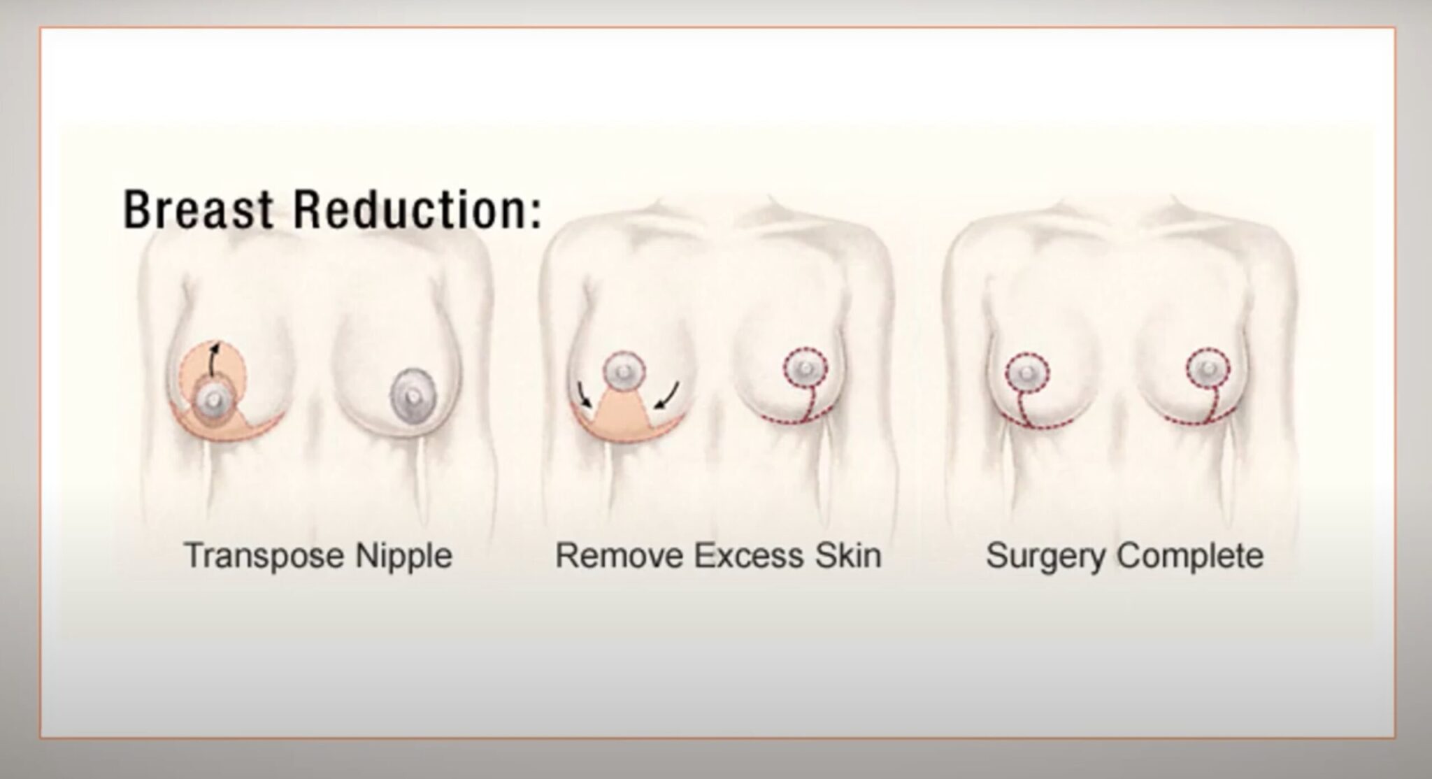 Boob reduction surgery