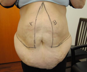 Before and after abdominoplasty photos