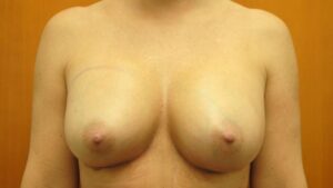 breast augment