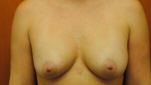 breast augment