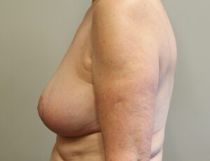 breast enhancement