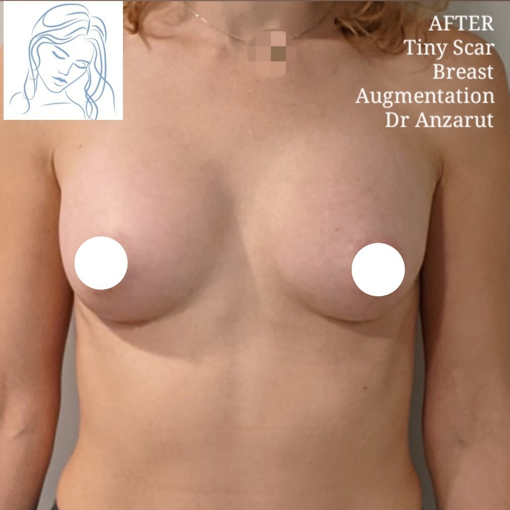 Dr. Anzarut Tiny Scar Breast Augmentation After