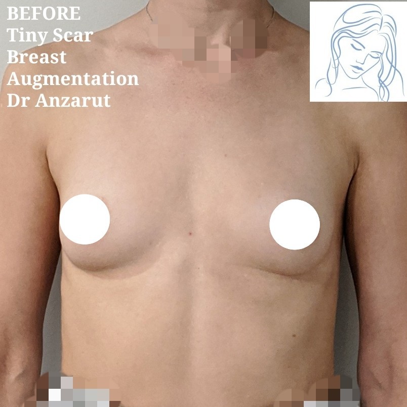 Dr. Anzarut Tiny Scar Breast Augmentation Before