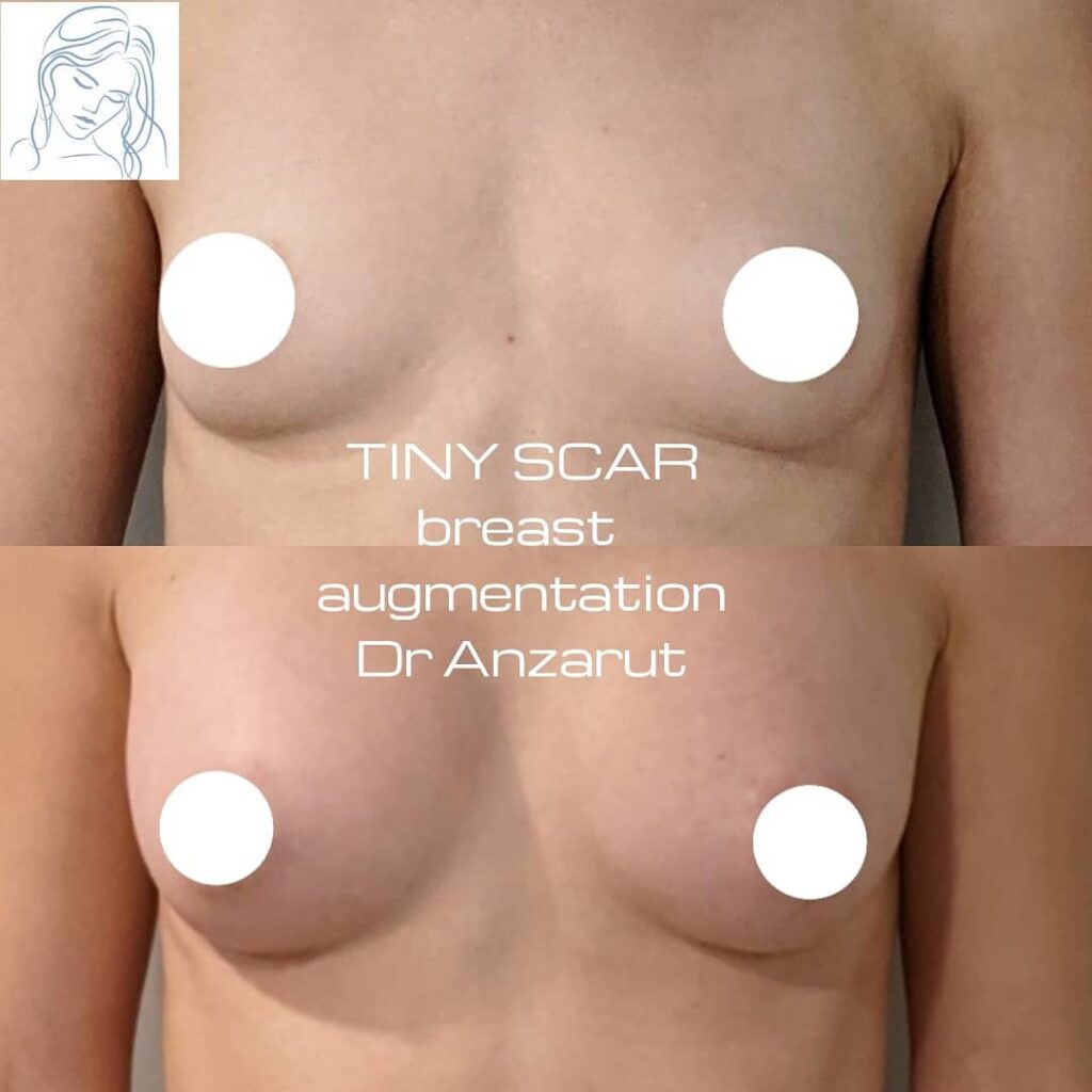 Dr. Anzarut Tiny Scar Breast Augmentation Plastic Surgery