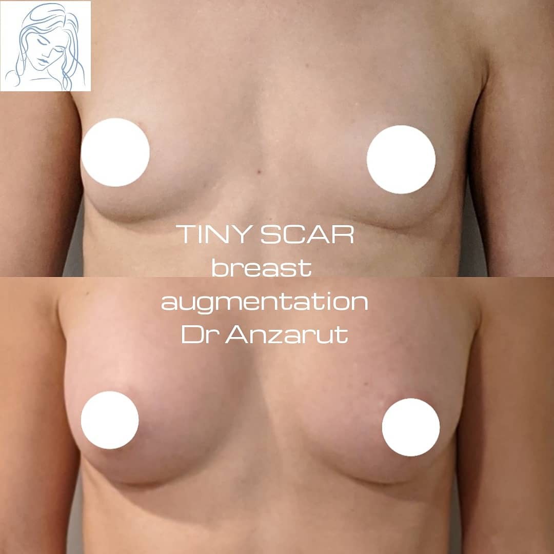 Tiny Scar Breast Augmentation Banner By Dr. Anzarut Plastic Surgeon