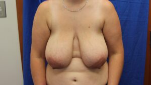breast enhancement