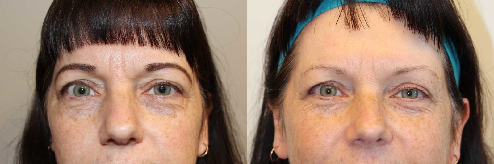 Eyelid Surgery Blepharoplasty Before And After Photos Dr Anzarut My Xxx Hot Girl 