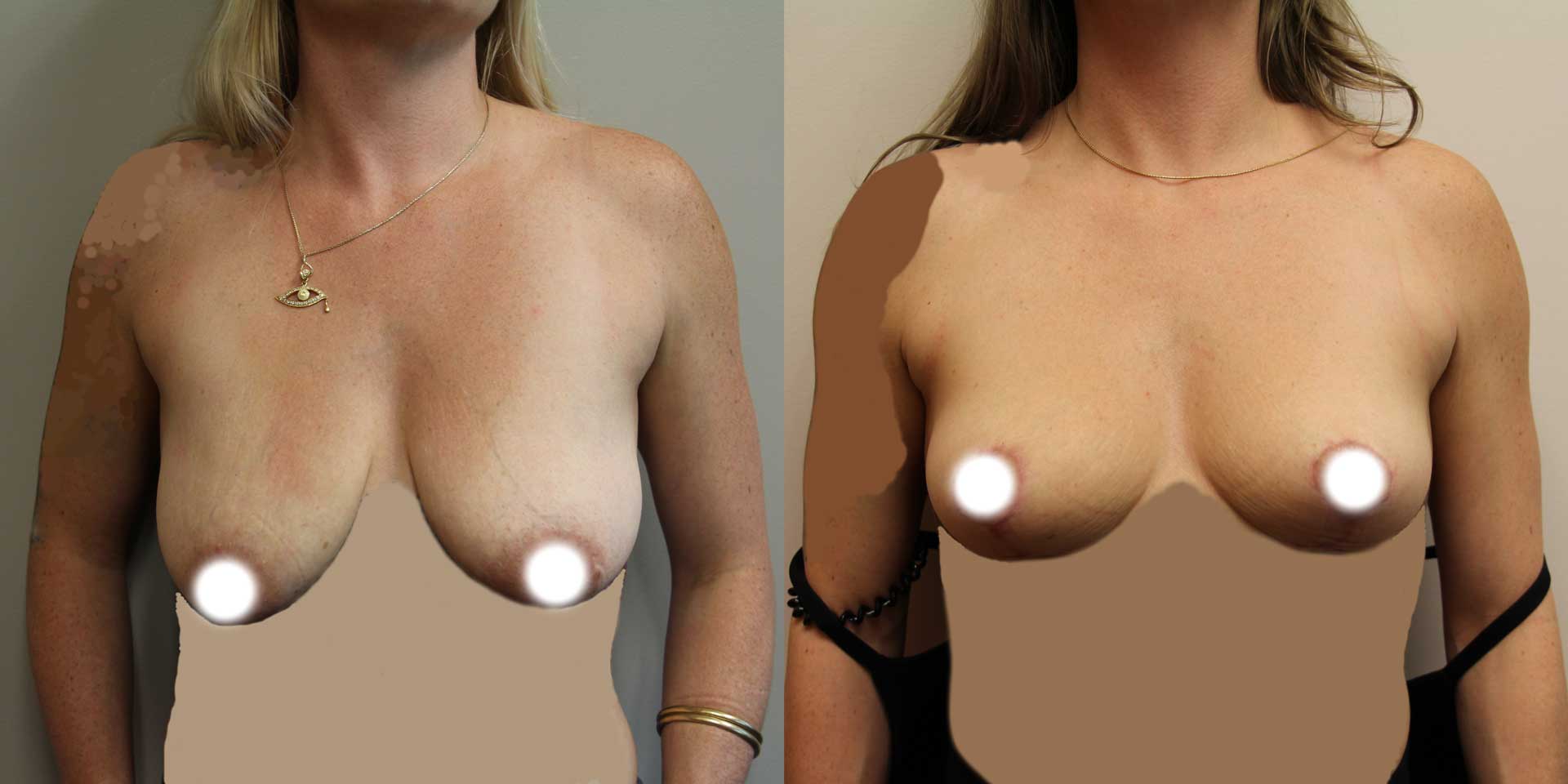breast lift 13093 before after front 01