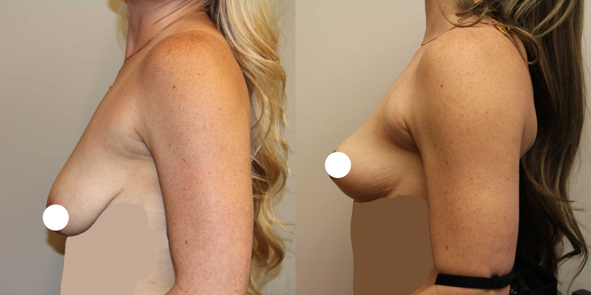 breast lift 13093 before after side 01