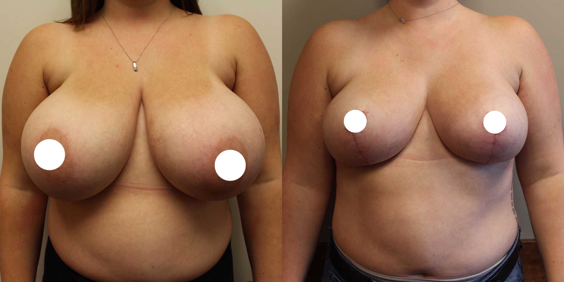 breast reduction 1636 before after front 02