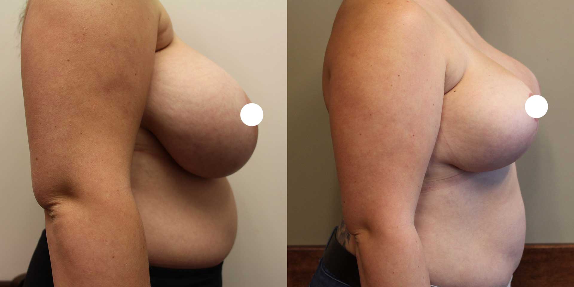 breast reduction 1636 before after side 02