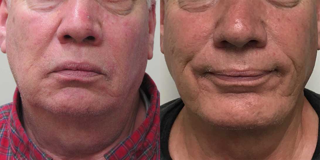 chin augmentation 5465 before after front 02