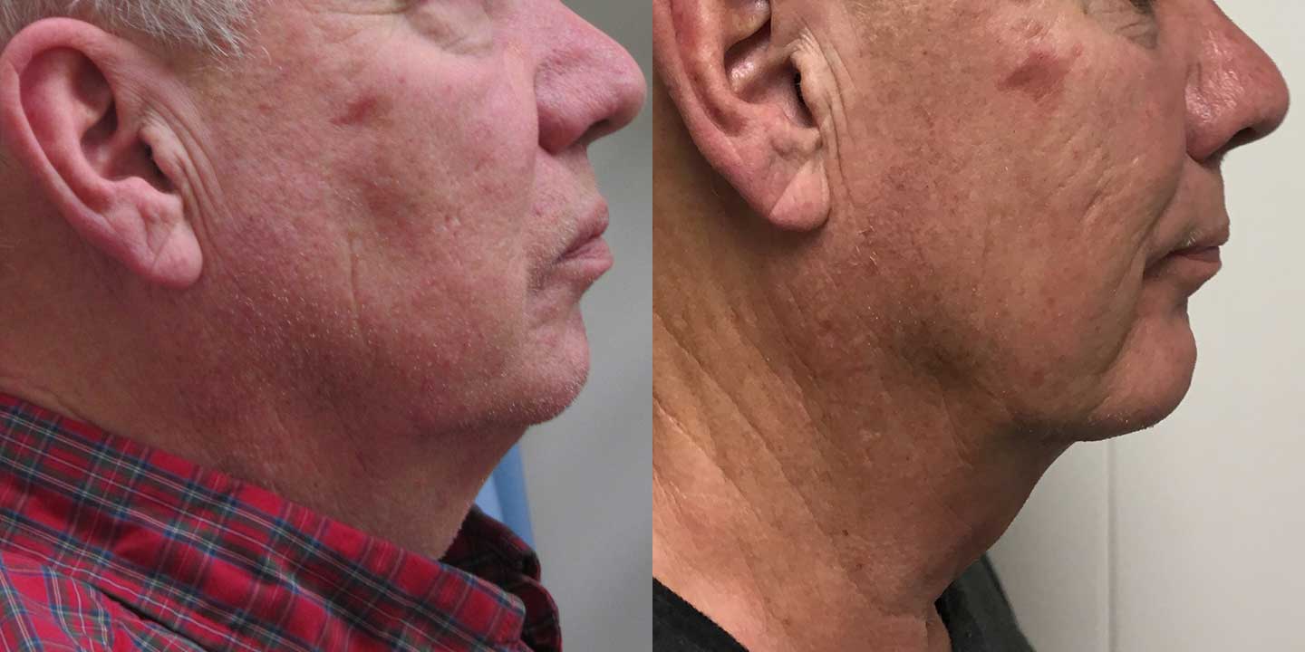 chin augmentation 5465 before and after side