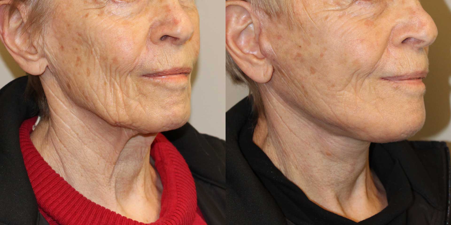 facelift 12959 before after 45 01