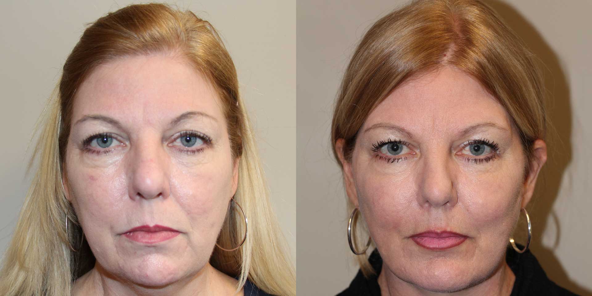 facelift 14425 before after front 05 face lift surgery vancouver, burnaby, coquitlam, richmond, delta, bc