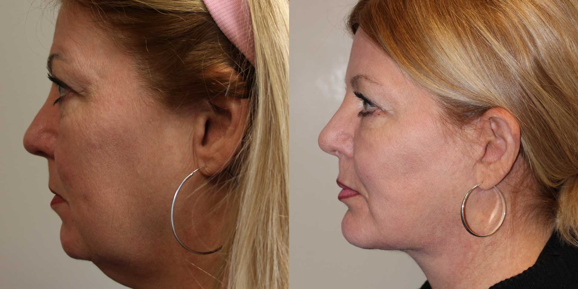 case 14425 neck lift surgery before and after photo side view