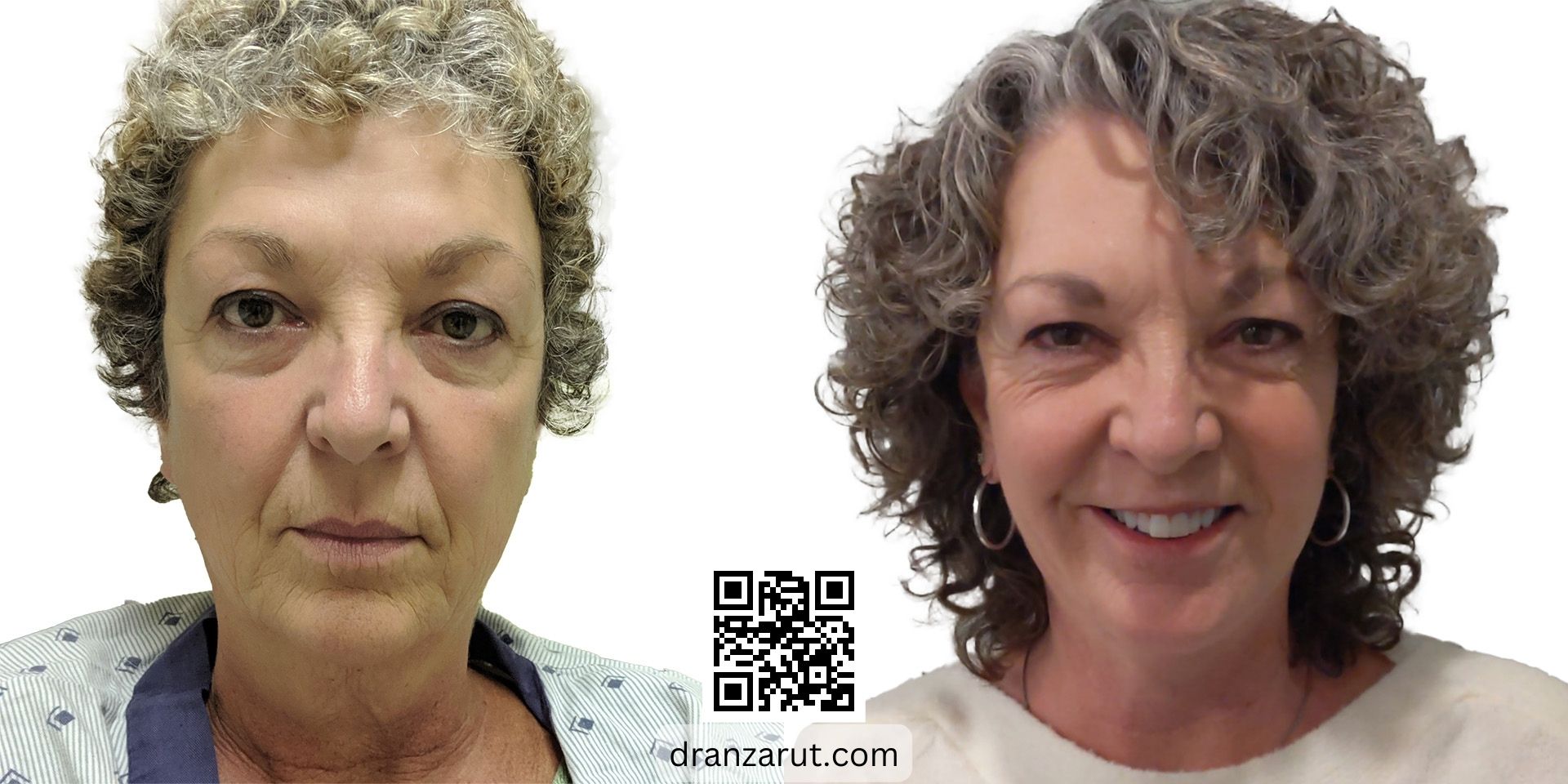facelift and neck sculpting before after case 18385 front