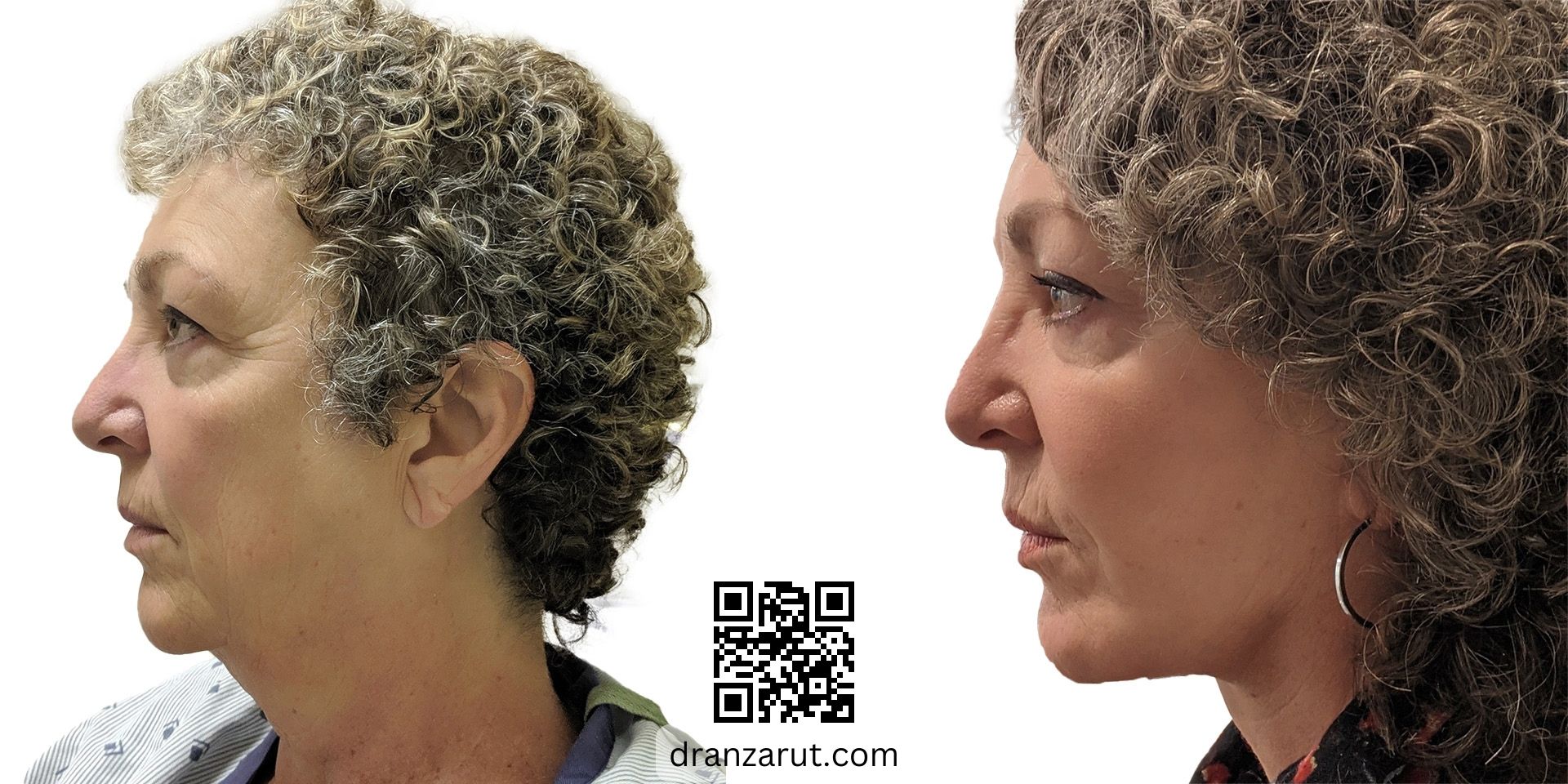 facelift and neck sculpting before after case 18385 left
