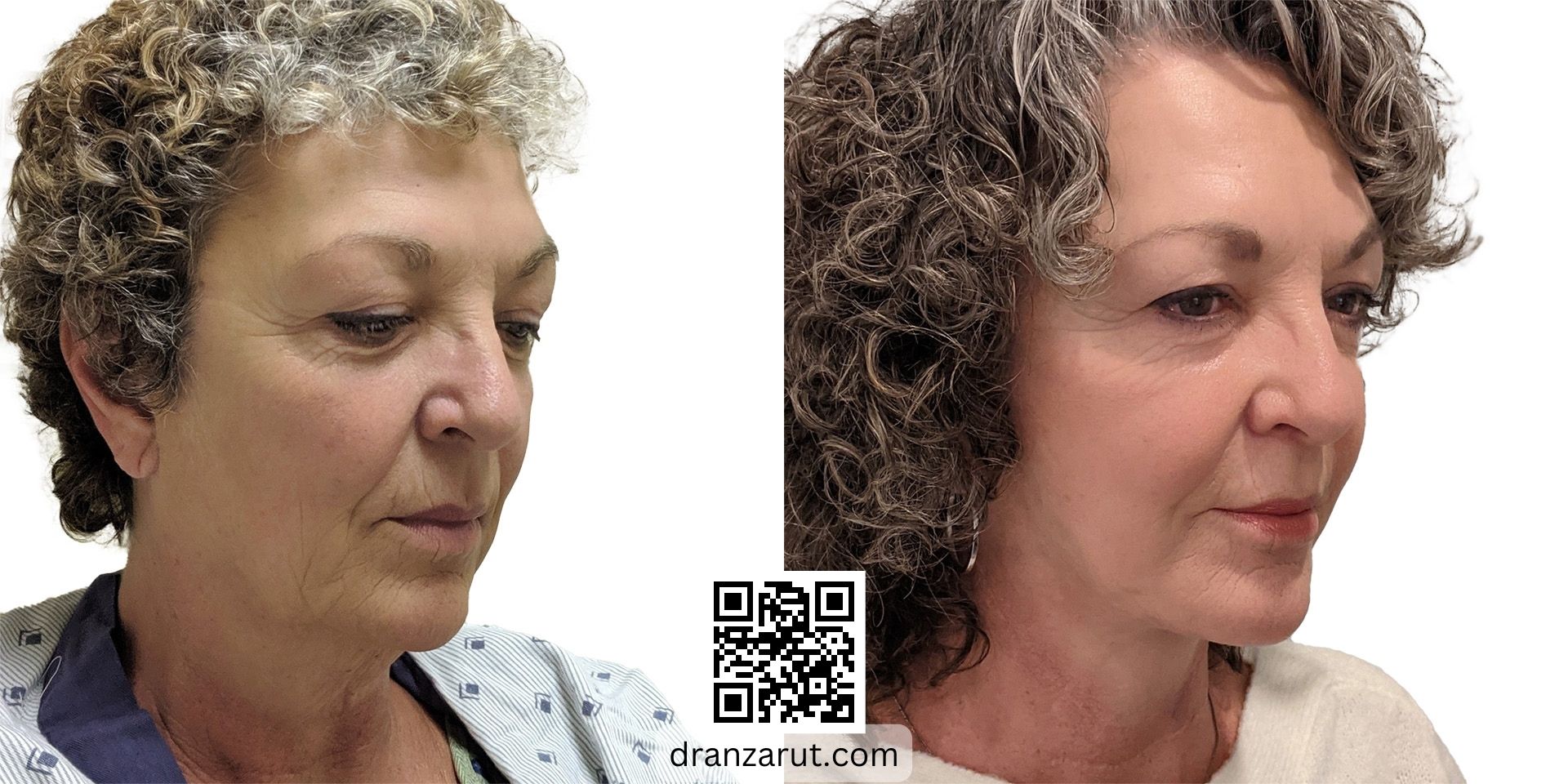facelift and neck sculpting before after case 18385 right oblique