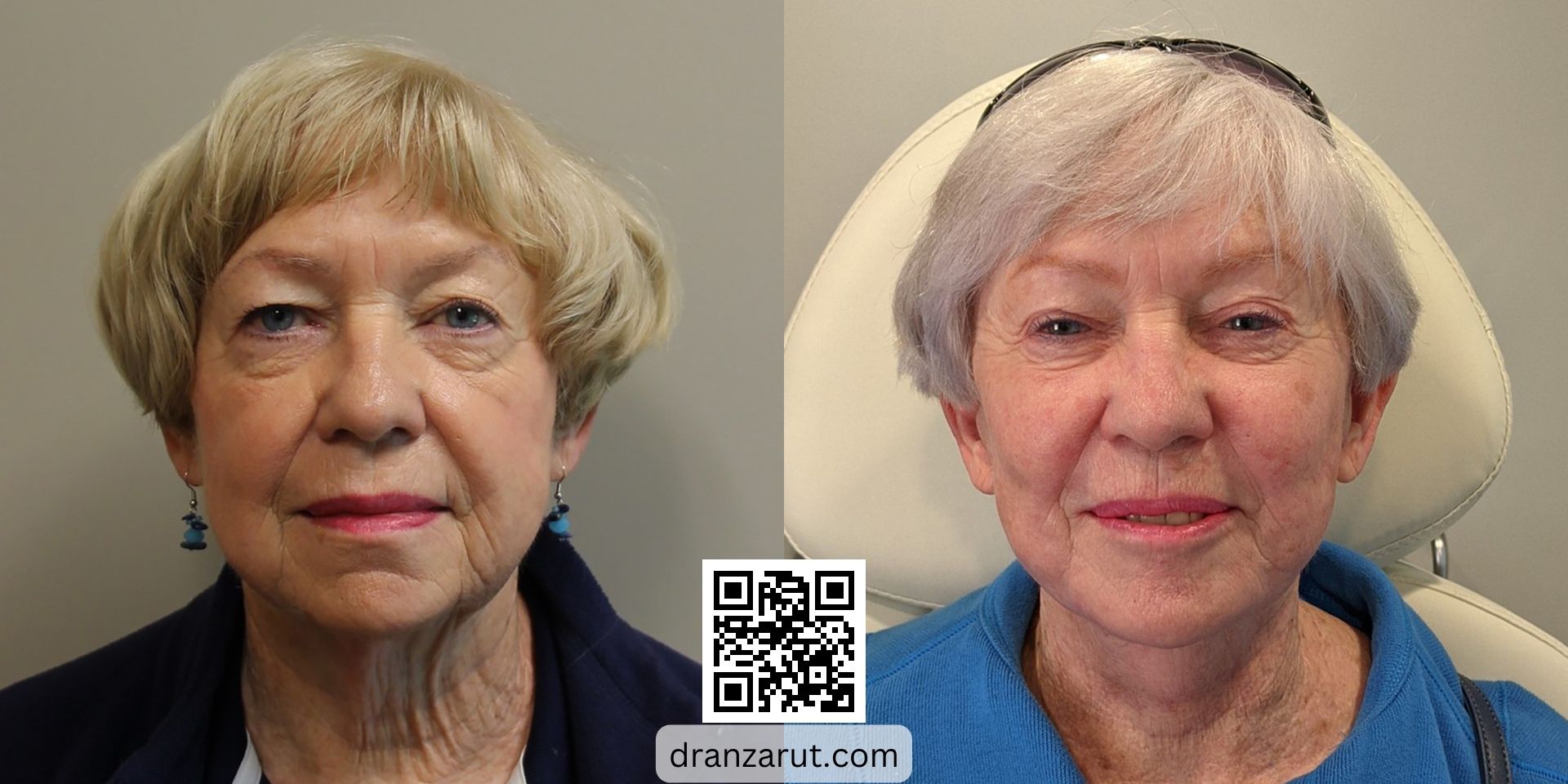 Facelift and neck sculpting before and after case 5566 front 2 years after Dr Anzarut