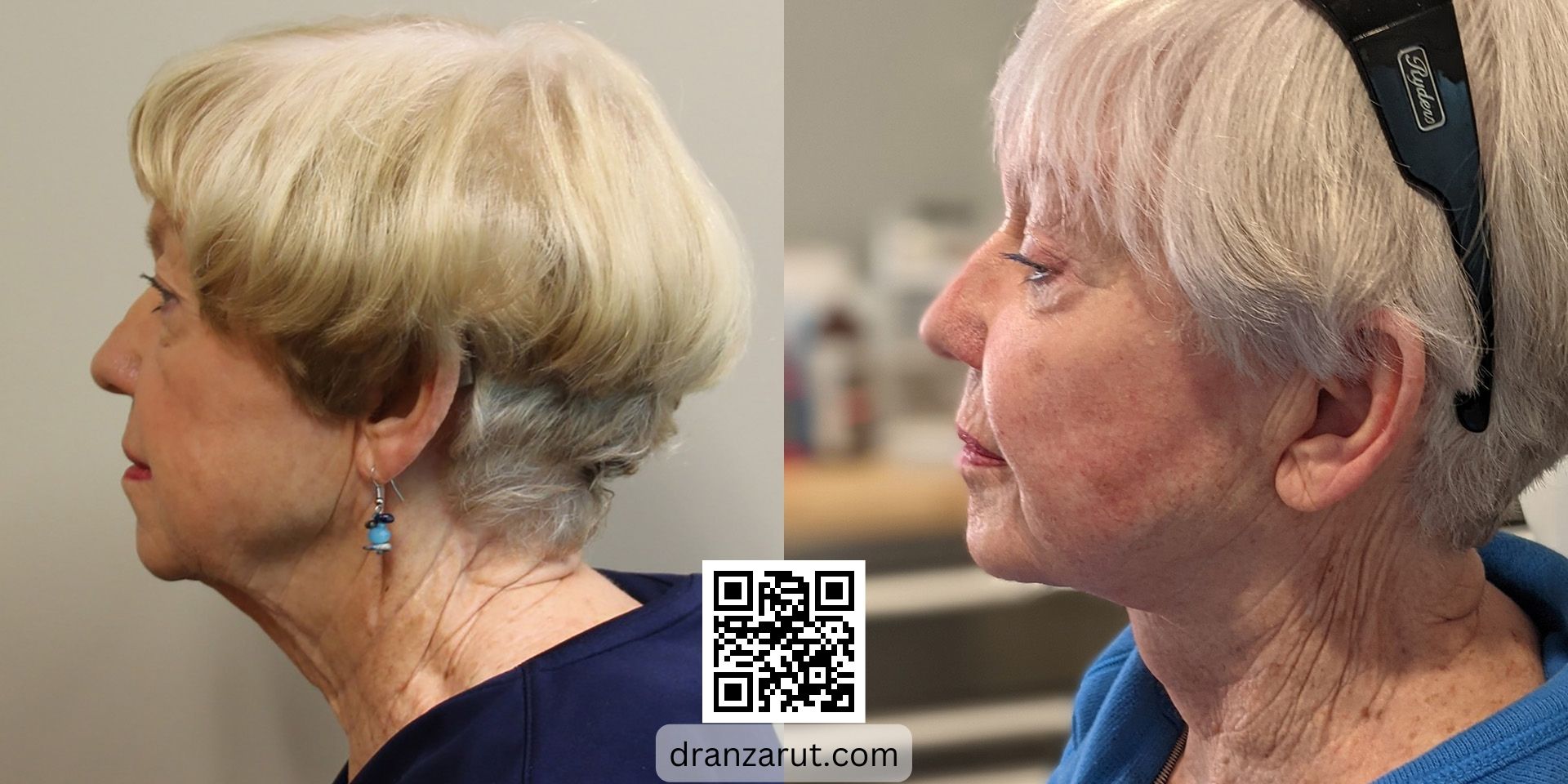 Facelift and neck sculpting before and after case 5566 left 2 years after Dr Anzarut