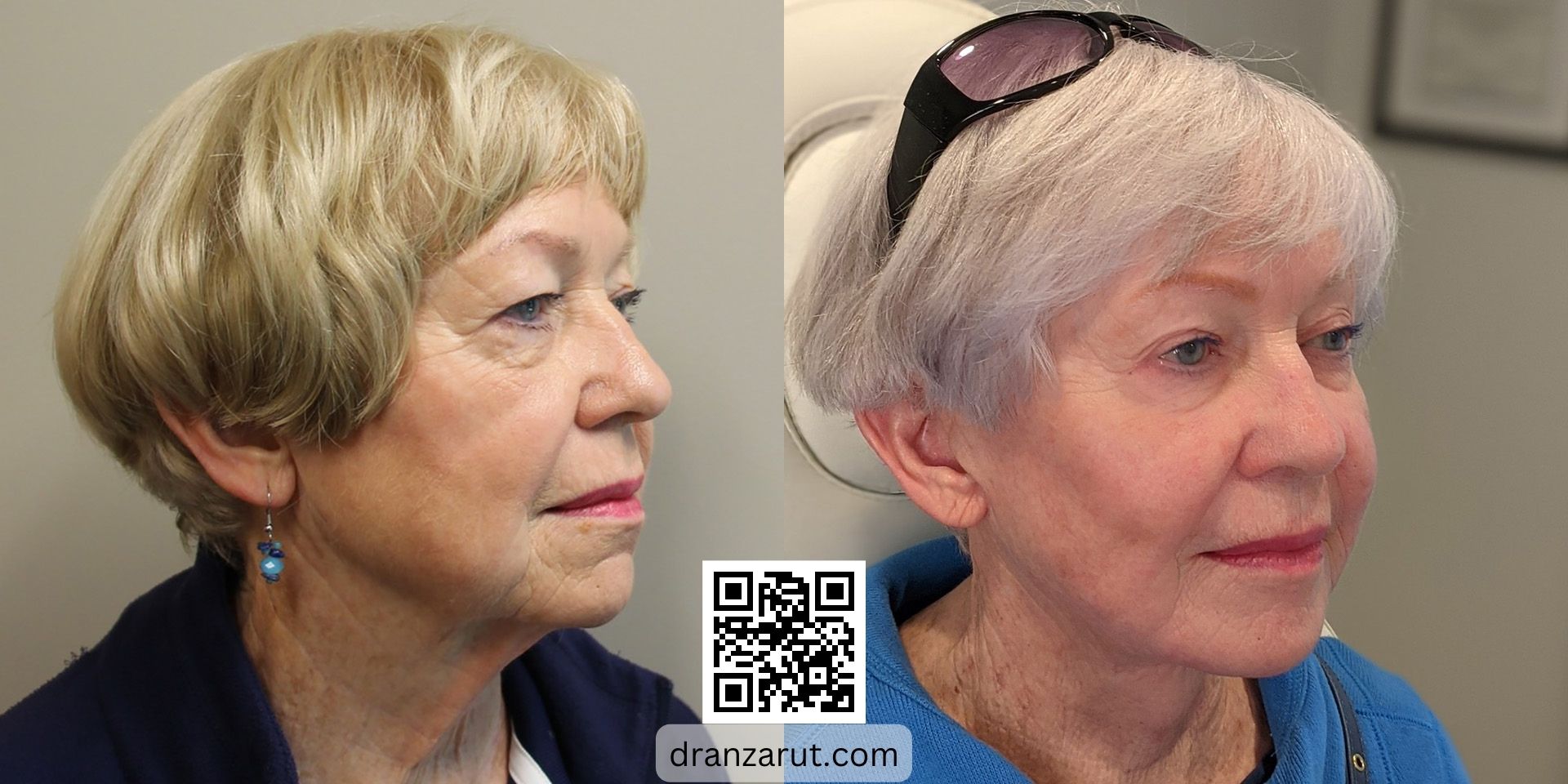 Facelift and neck sculpting before and after case 5566 right oblique 2 years after Dr Anzarut