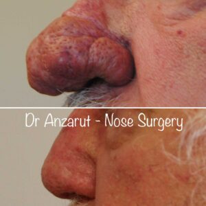 rhinoplasty 4608 before after side 01