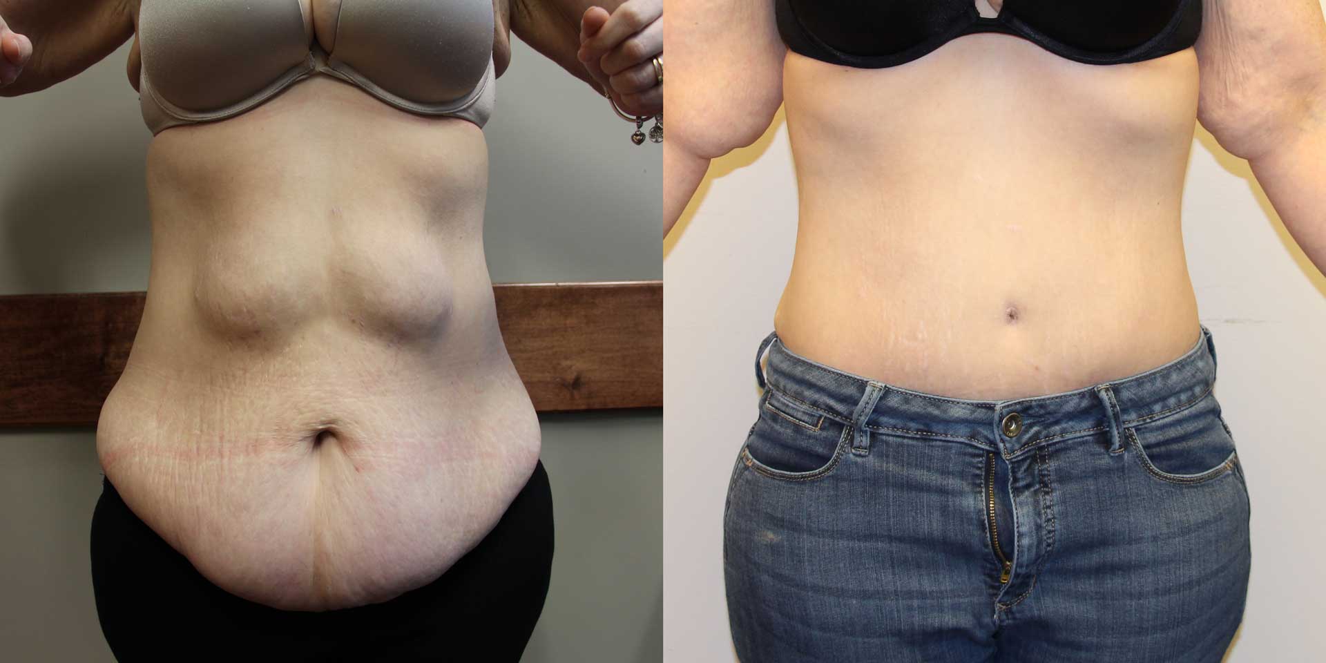 before and after tummy tuck in clothes