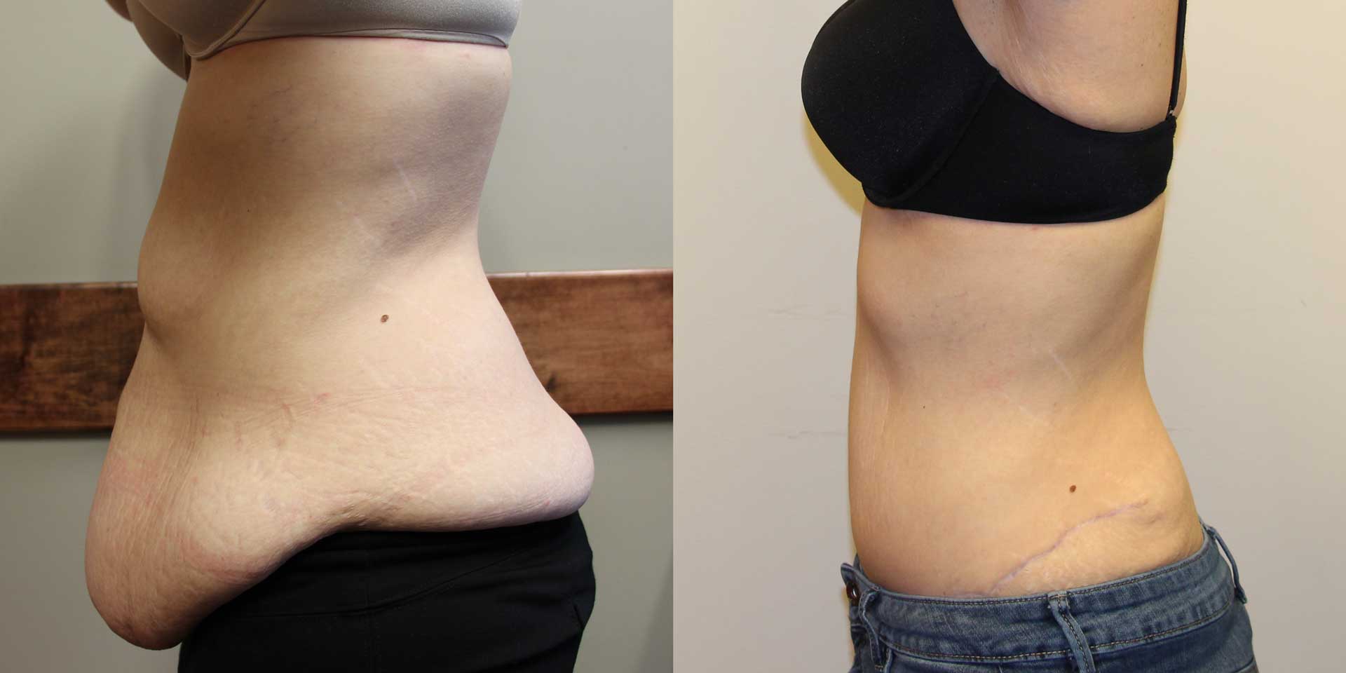 tummy tuck 14421 before after side 01