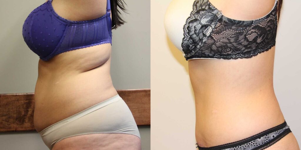Tummy Tuck Abdominoplasty Before And After Photos Dr Anzarut Plastic Surgery 