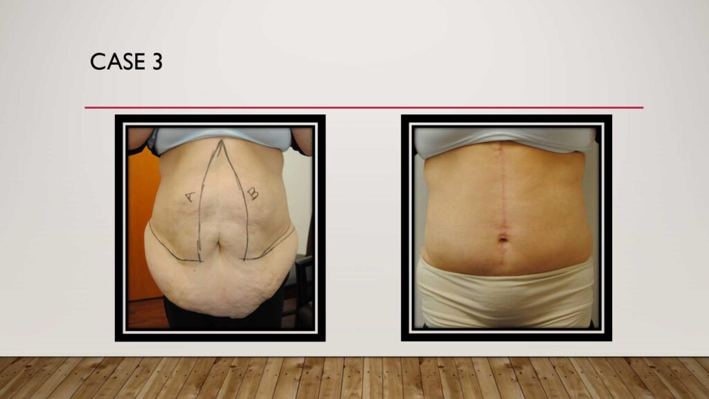 mini tummy tuck before and after nyc